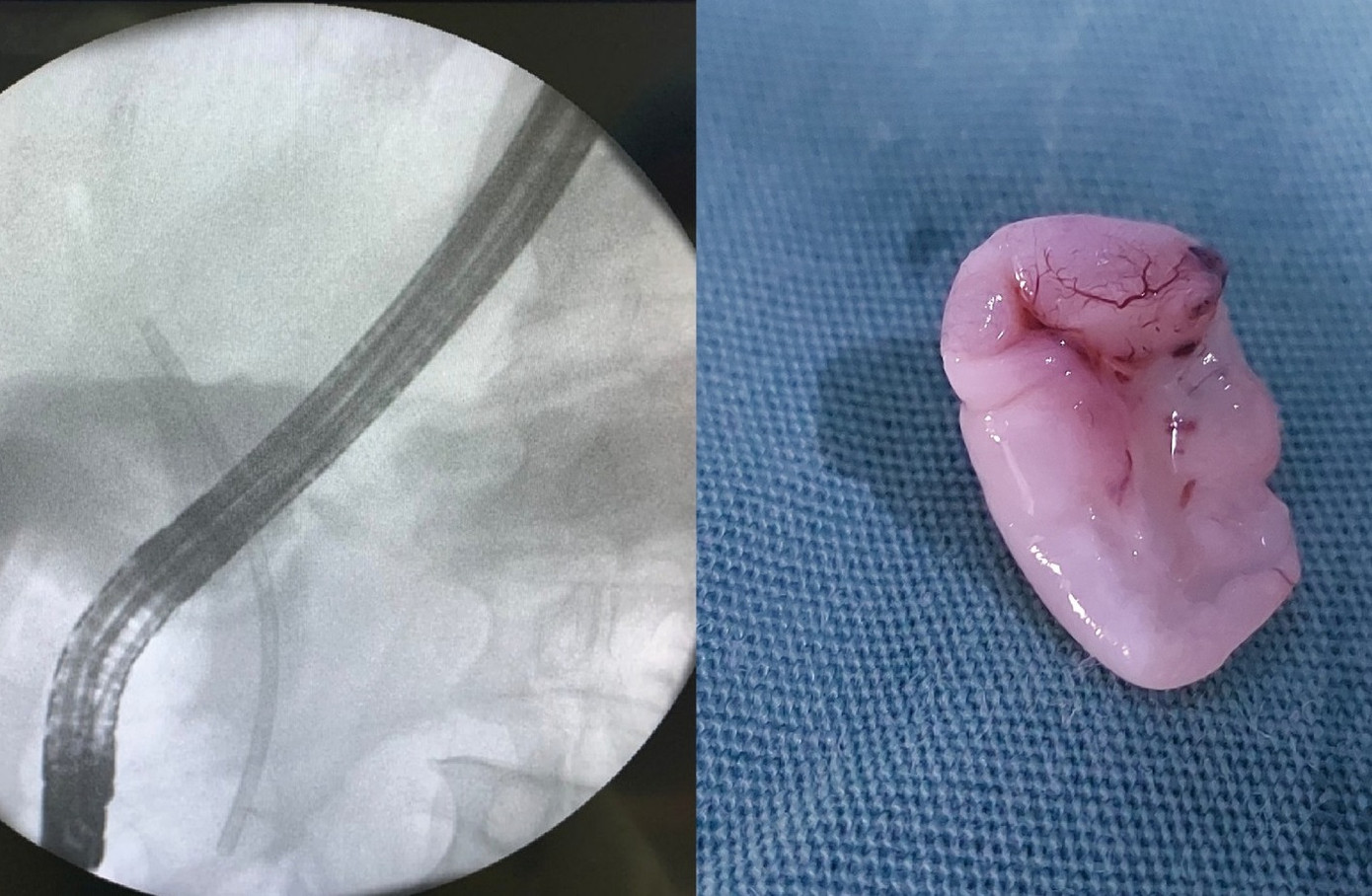 Sán lá gan có kích thước lớn trong ống mật chủ của bệnh nhân được bác sĩ thực hiện nội soi gắp ra ngoài