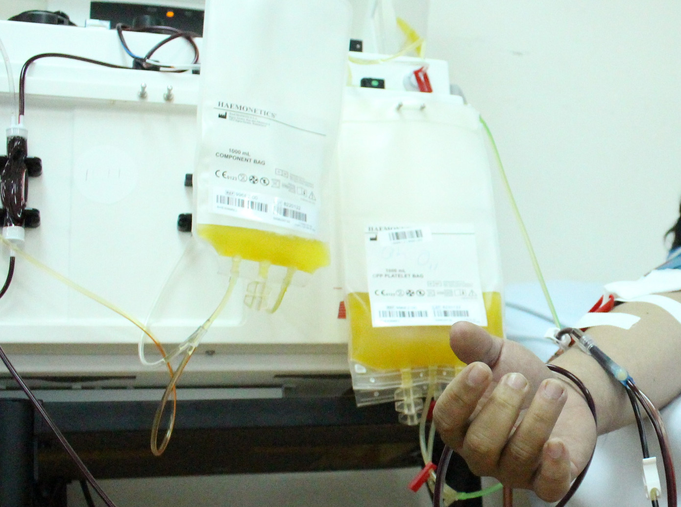 Thay huyết tương là phương pháp được chỉ định để điều trị bệnh viêm tủy cắt ngang Thay huyết tương là phương pháp được chỉ định để điều trị bệnh viêm tủy cắt ngang