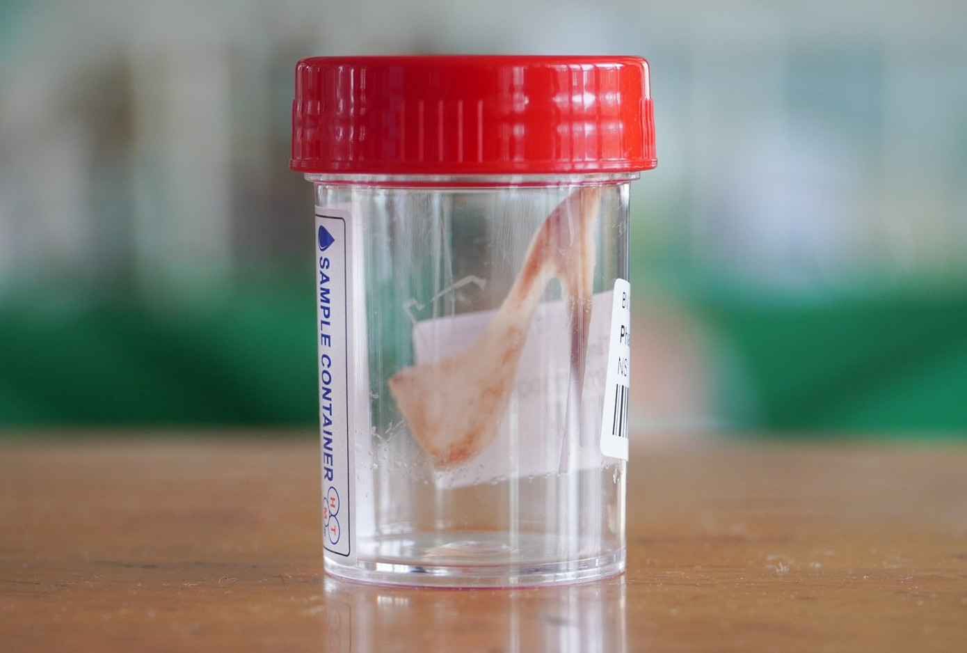 Một chiếc xương gia cầm được các bác sĩ phẫu thuật, lấy ra từ thực quản của người bệnh