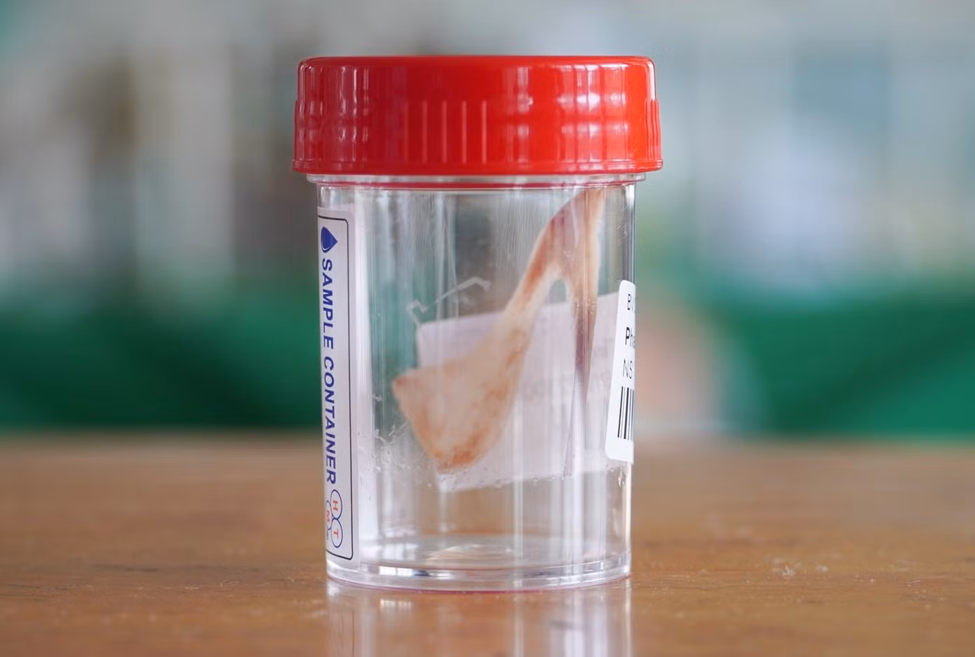 Một chiếc xương gia cầm được các bác sĩ phẫu thuật, lấy ra từ thực quản của người bệnh