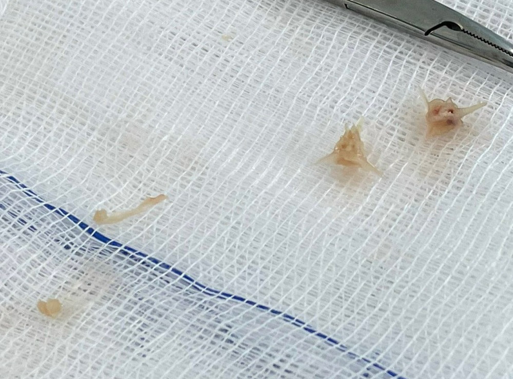 Những mảnh xương lươn sắc nhọn được bác sĩ lấy ra từ khối áp xe vùng trung thất ở bệnh nhi Những mảnh xương lươn sắc nhọn được bác sĩ lấy ra từ khối áp xe vùng trung thất ở bệnh nhi