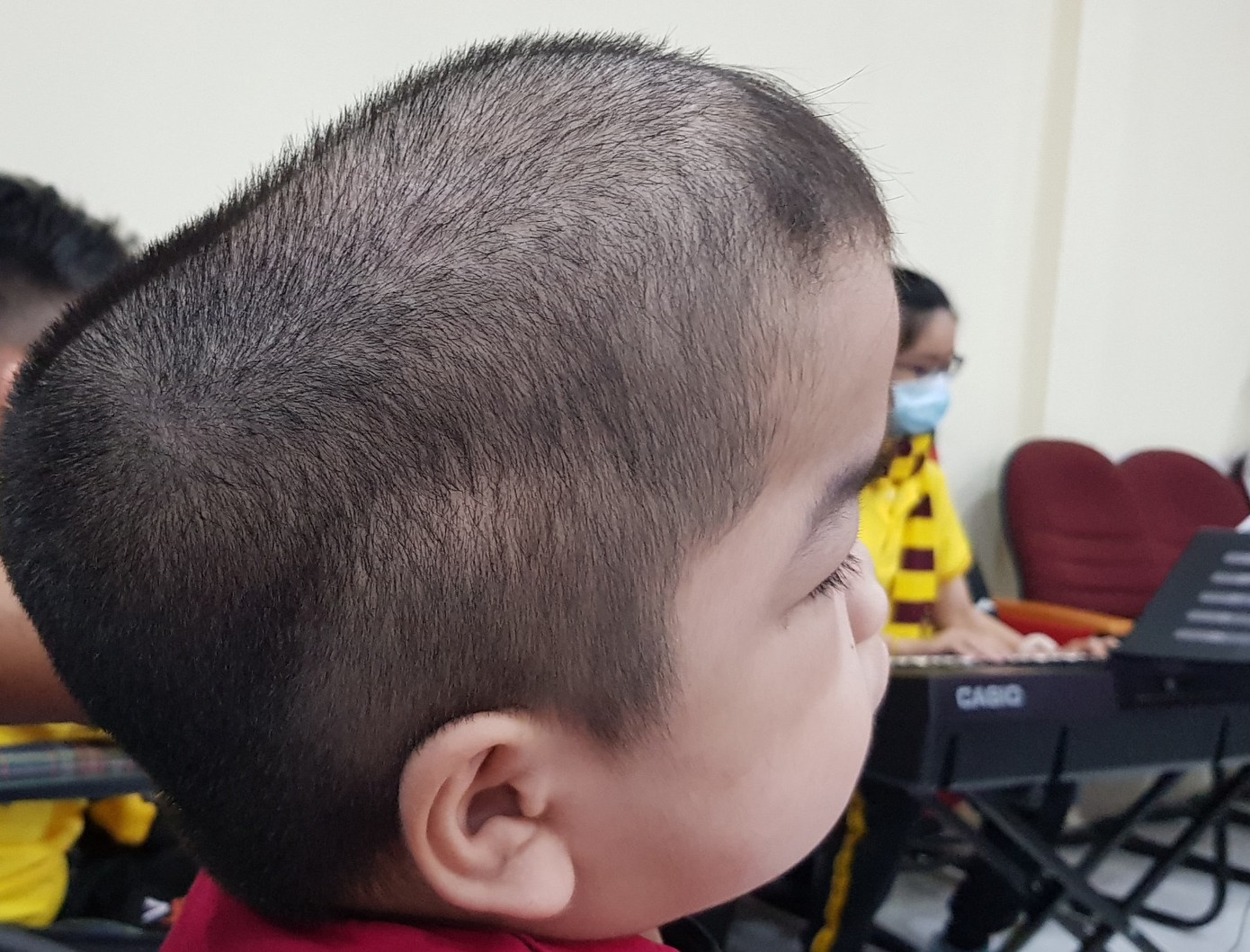 Một trường hợp trẻ mắc bệnh hiếm khiến hộp sọ ngày càng phát triển lớn đang được theo dõi, điều trị tại Nhi Đồng 1