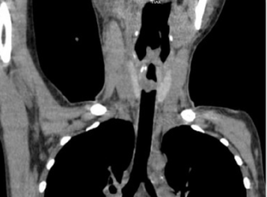 Khối u lớn gây tắc gần như hoàn toàn khí quản khiến bệnh nhân suy hấp cấp, nguy kịch Khối u lớn gây tắc gần như hoàn toàn khí quản khiến bệnh nhân suy hấp cấp, nguy kịch