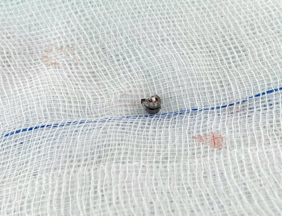 Viên đạn chì cắm vào xương sọ bệnh nhi được các bác sĩ tiến hành phẫu thuật lấy ra ngoài