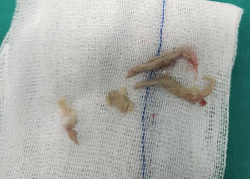 Dị vật là miếng thịt "bỏ quên" suốt 3 tháng trong đường thở khiến trẻ ho, khó thở kéo dài Dị vật là miếng thịt "bỏ quên" suốt 3 tháng trong đường thở khiến trẻ ho, khó thở kéo dài