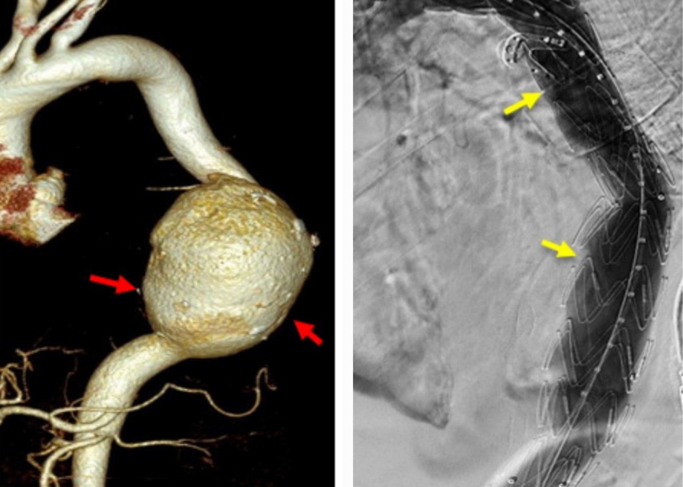 Túi phình động mạch chủ ngực của bệnh nhân trước khi vỡ và sau khi được can thiệp Túi phình động mạch chủ ngực của bệnh nhân trước khi vỡ và sau khi được can thiệp
