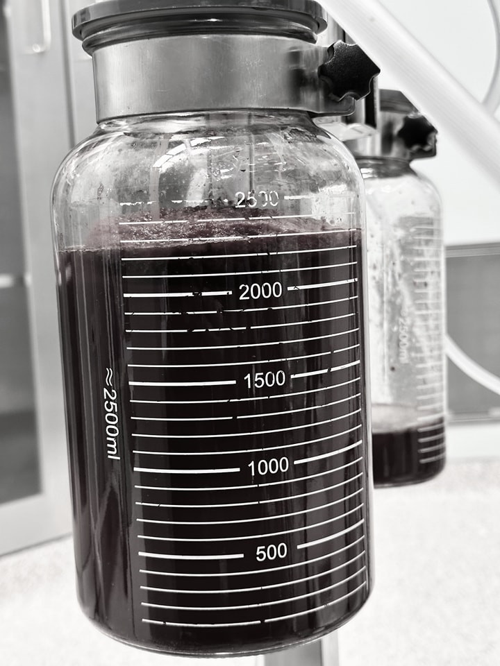 Lượng máu rất lớn tràn vào ổ bụng của bệnh nhi được hút ra ngoài Lượng máu rất lớn tràn vào ổ bụng của bệnh nhi được hút ra ngoài