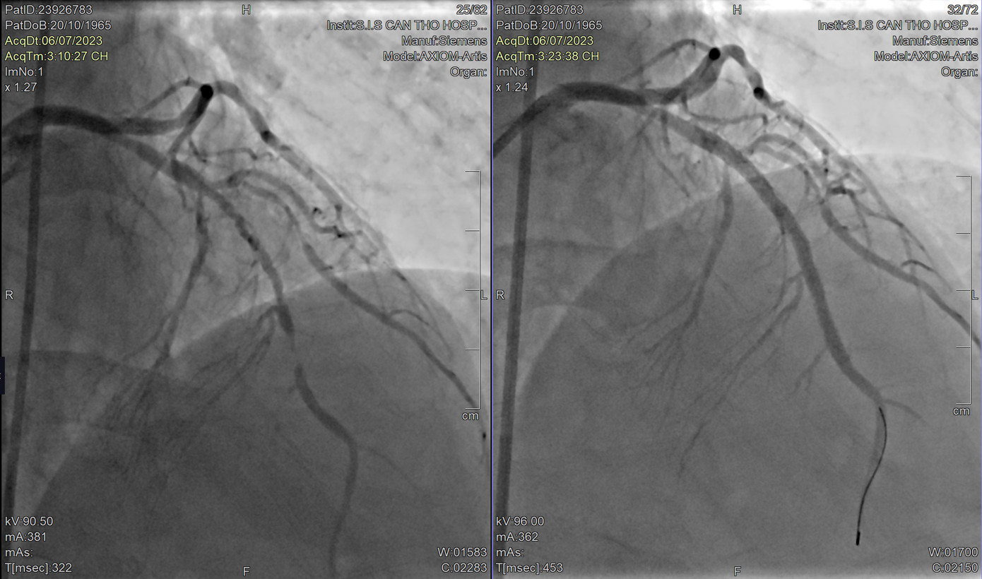 Động mạch vành của bệnh nhân trước can thiệp bị tắc nghẽn, sau can thiệp được tái thông hoàn toàn Động mạch vành của bệnh nhân trước can thiệp bị tắc nghẽn, sau can thiệp được tái thông hoàn toàn