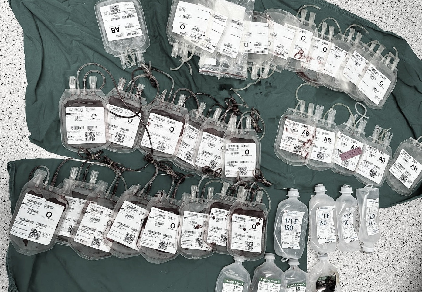 Các bác sĩ đã phải truyền bổ sung 4 lít máu cho bệnh nhân trong suốt cuộc phẫu thuật Các bác sĩ đã phải truyền bổ sung 4 lít máu cho bệnh nhân trong suốt cuộc phẫu thuật