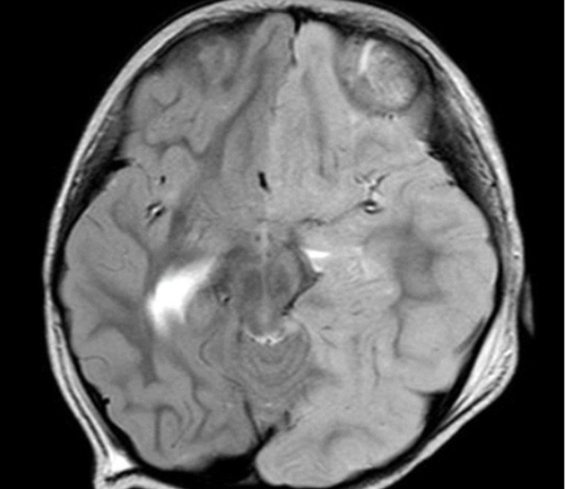Hình ảnh MRI chuỗi xung T2W của bệnh nhân N.H.X (ảnh: BVCC)