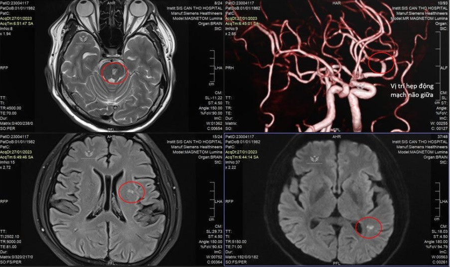 Vùng khoanh tròn trên kết quả kiểm tra hình ảnh là vị trí nhồi máu não ở bệnh nhân