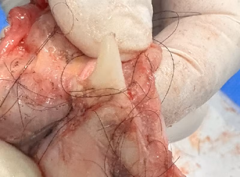 Các thành phần nang tóc và cấu trúc xương được bác sĩ phát hiện trong khối u sau phẫu thuật