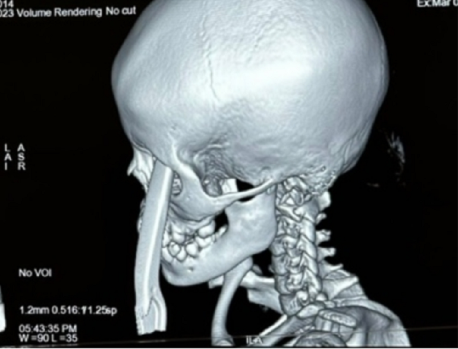 Bệnh nhi nhập viện trong tình trạng đau đớn do dị vật kim loại đâm vào hốc mắt Bệnh nhi nhập viện trong tình trạng đau đớn do dị vật kim loại đâm vào hốc mắt