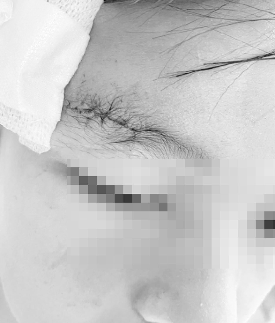 Bệnh nhi phải nhập viện cấp cứu sau khi khẩu súng hơi cướp cò khiến đạn bắn vào mặt