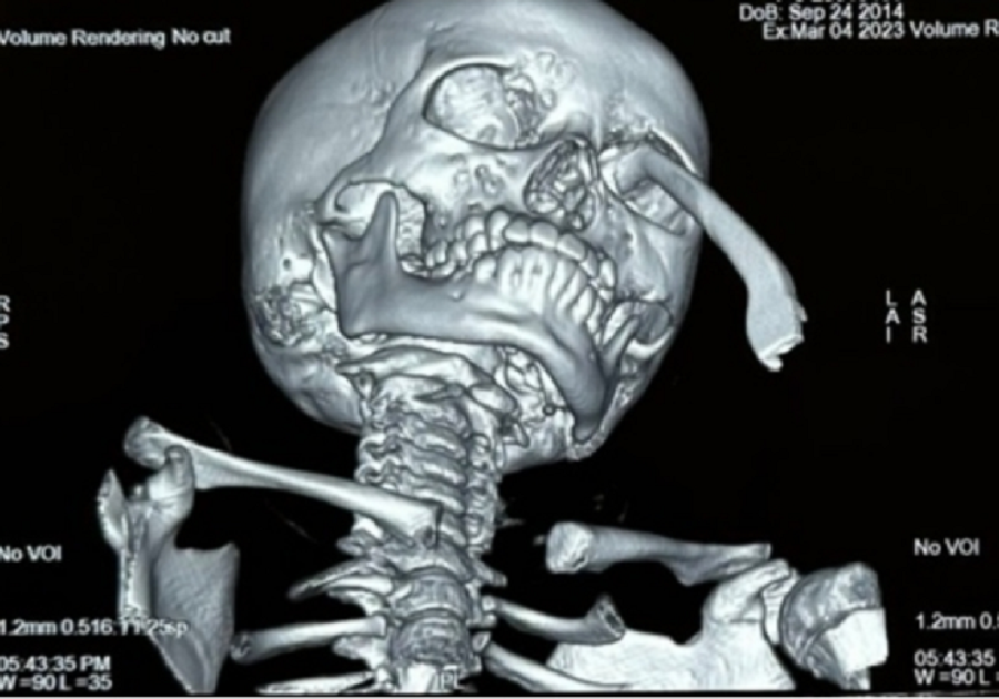 Dị vật khiến bệnh nhi bị tổn thương nặng phải thực hiện cuộc phẫu thuật cấp cứu Dị vật khiến bệnh nhi bị tổn thương nặng phải thực hiện cuộc phẫu thuật cấp cứu