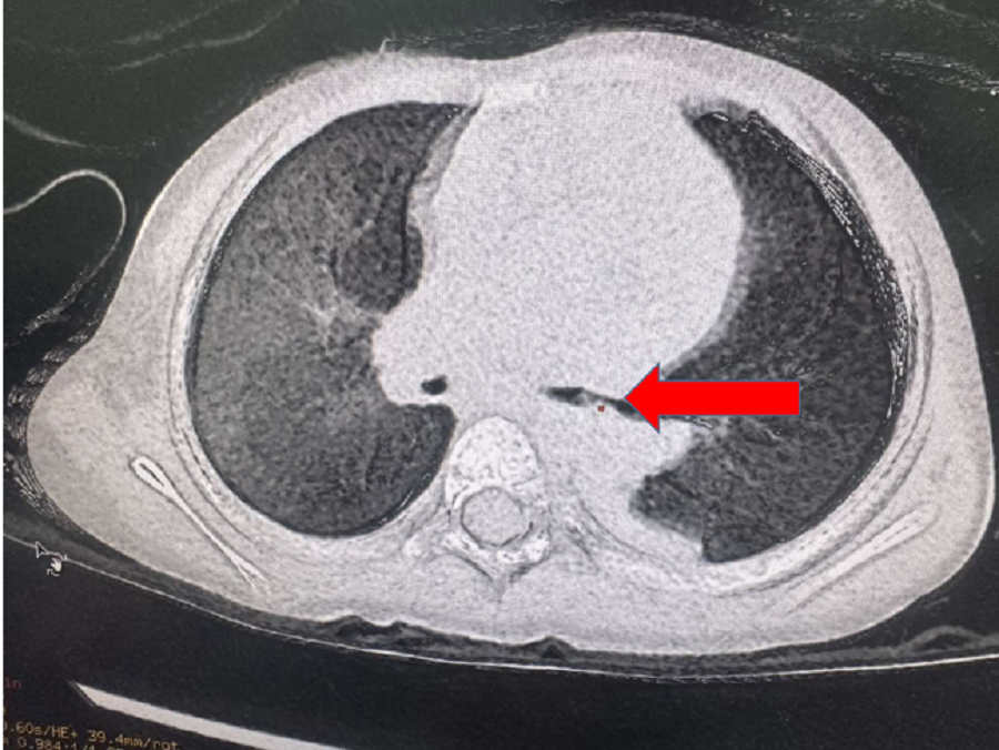 Hình ảnh kiểm tra ghi nhận dị vật lấp đầy phế quản bên trái của bệnh nhi Hình ảnh kiểm tra ghi nhận dị vật lấp đầy phế quản bên trái của bệnh nhi
