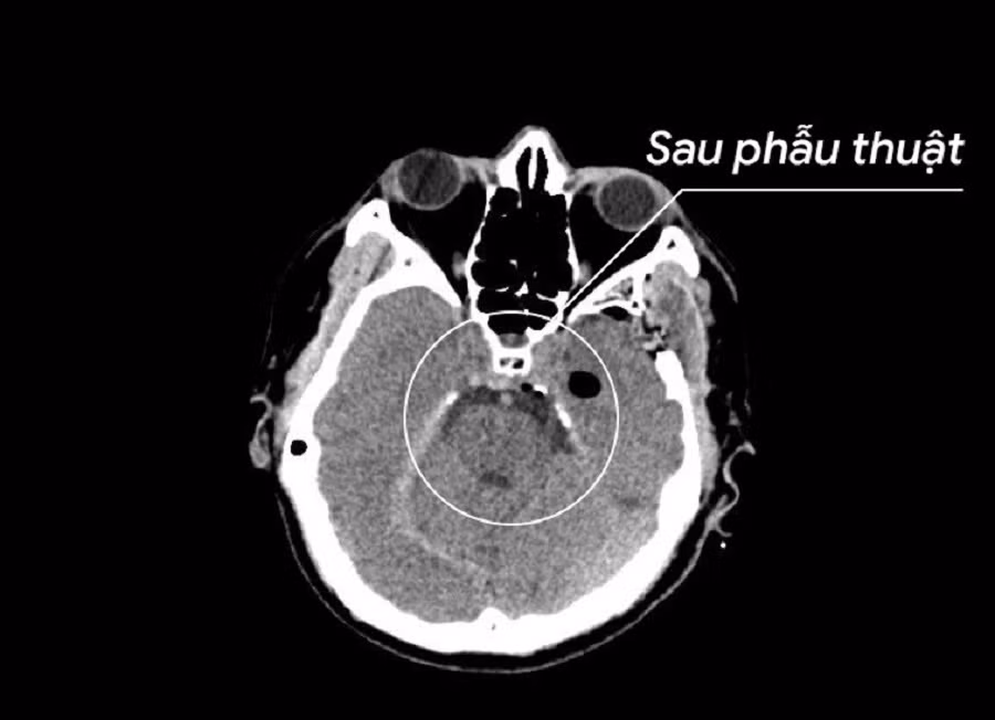 Kết quả kiểm tra sau phẫu thuật, khối u đã được loại bỏ triệt để, sức khỏe bệnh nhân bình phục tốt