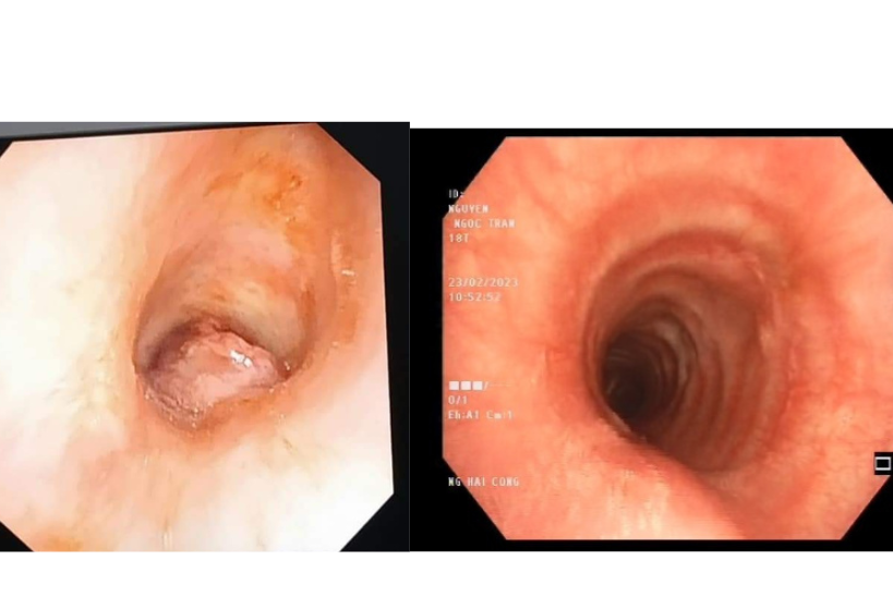 Hình ảnh nội soi khí quản của bệnh nhân trước và sau khi thực hiện thủ thuật cắt đốt khối u Hình ảnh nội soi khí quản của bệnh nhân trước và sau khi thực hiện thủ thuật cắt đốt khối u