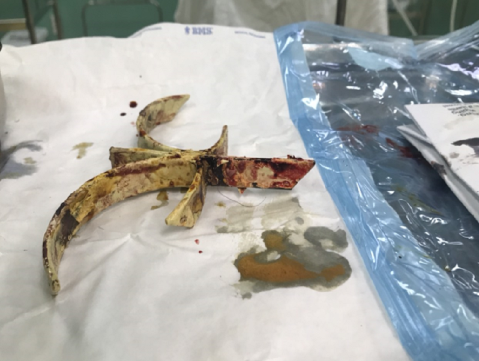 Di vật được lấy ra khỏi cơ thể Di vật được lấy ra khỏi cơ thể