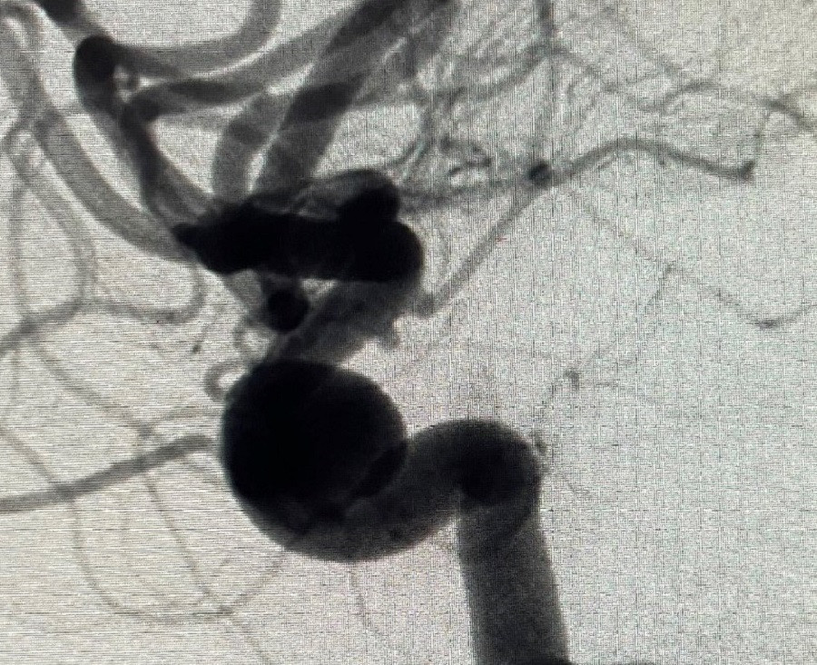 Túi phình lớn ở mạch máu não dọa vỡ là nguyên nhân khiến người bệnh bị đau đầu dữ dội