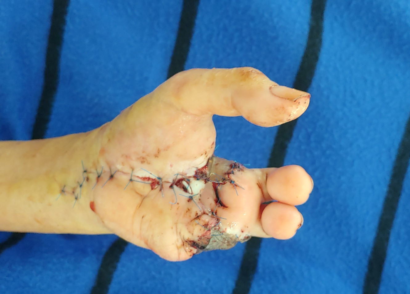 Sau khi ghép, 2 ngón chân đang sống tốt trên bàn tay để duy trì chức năng cầm nắm