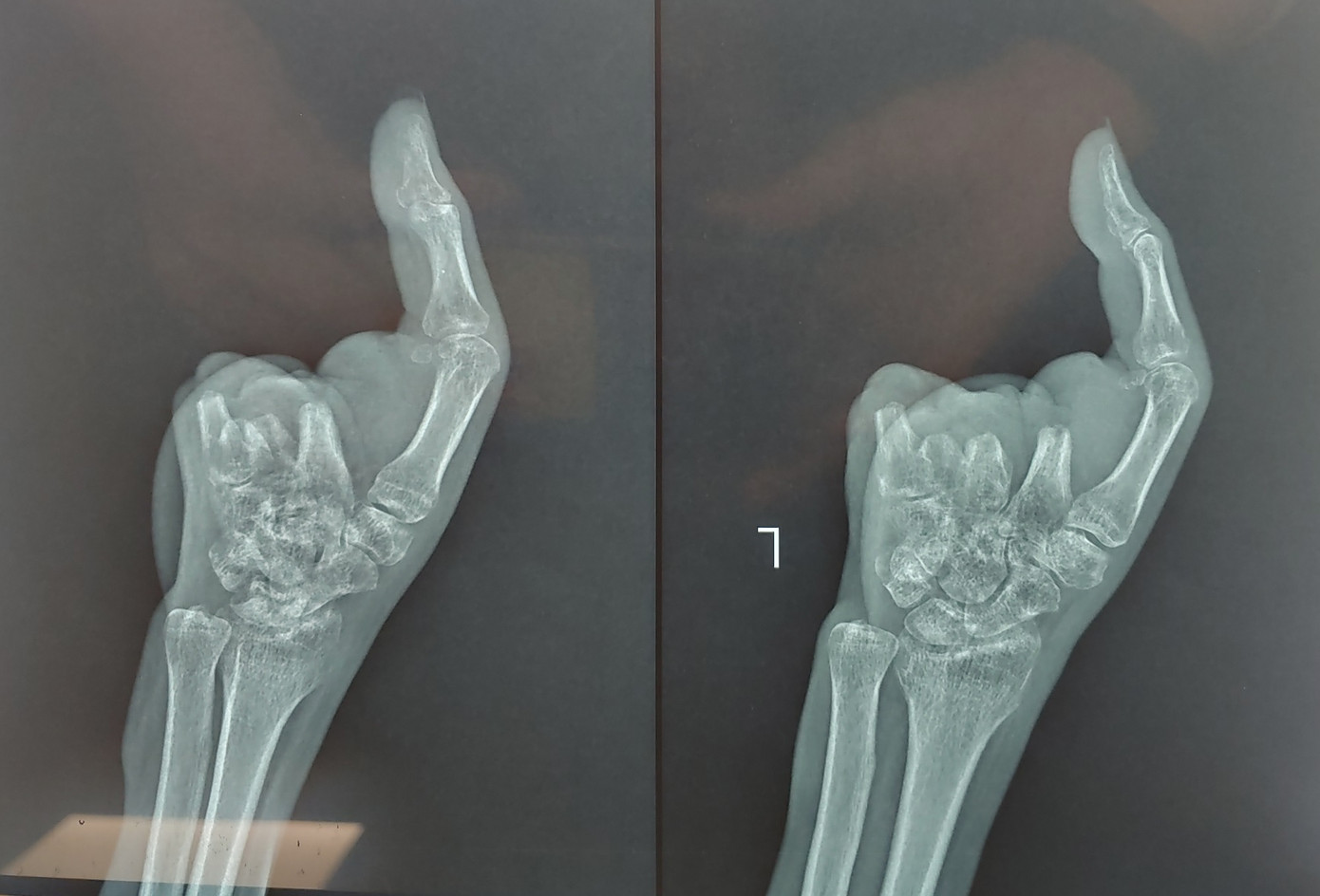 Bàn tay bệnh nhân bị cụt mất 4 ngón sau khi bị máy xay thịt cuốn nát