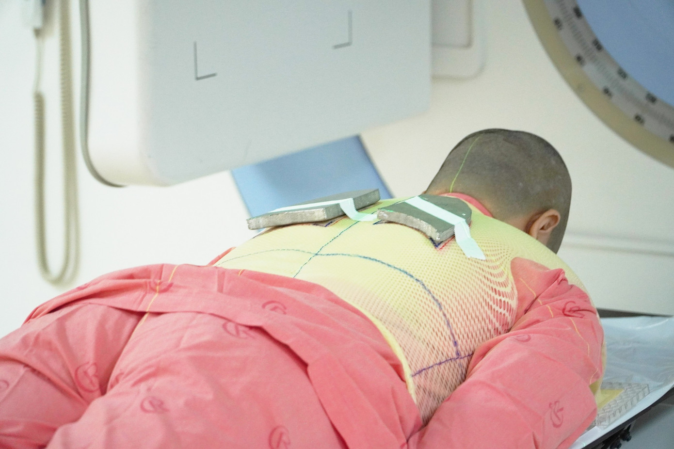 Sau khi xạ trị toàn thân và ghép tế bào gốc đồng loại, bệnh nhân đã trở lại cuộc sống bình thường