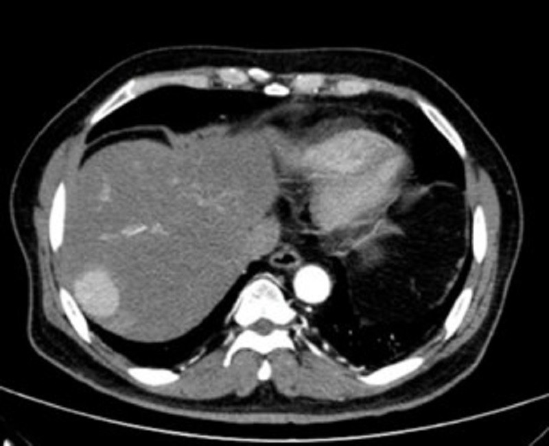 Hình ảnh kiểm tra phát hiện khối ung thư nằm vị trí sát rìa gan của người bệnh Hình ảnh kiểm tra phát hiện khối ung thư nằm vị trí sát rìa gan của người bệnh