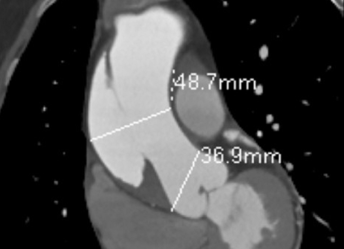 Hình ảnh kiểm tra cho thấy vị trí lóc tách động mạch chủ rất nặng ở bệnh nhân