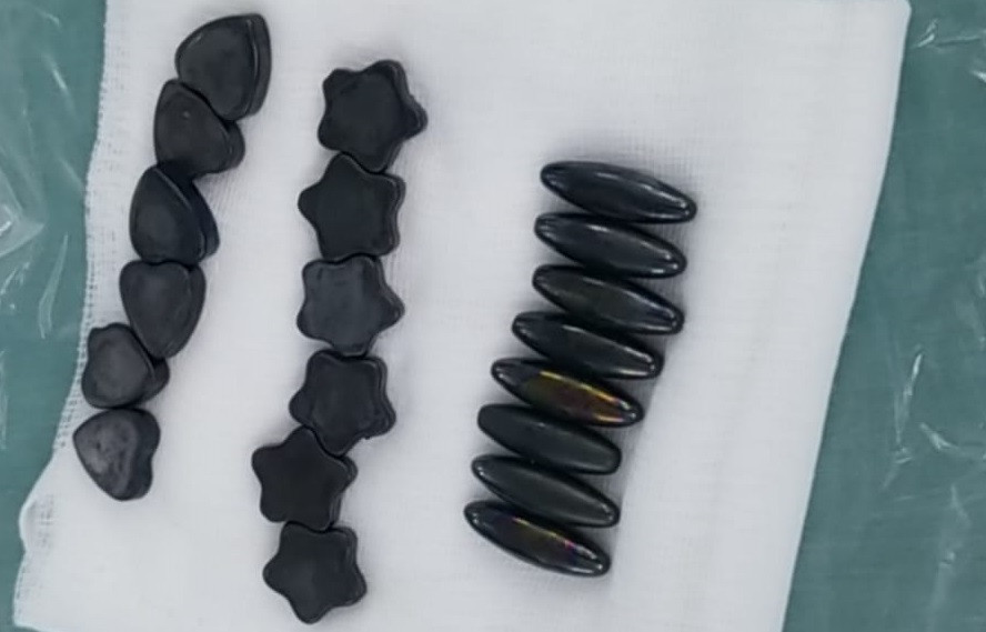 Những viên nam châm được bác sĩ phẫu thuật lấy ra từ đường tiêu hóa của bệnh nhi Những viên nam châm được bác sĩ phẫu thuật lấy ra từ đường tiêu hóa của bệnh nhi