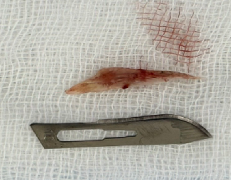 Chiếc xương cá dài 3cm là nguyên nhân khiến người bệnh rơi vào nguy kịch Chiếc xương cá dài 3cm là nguyên nhân khiến người bệnh rơi vào nguy kịch