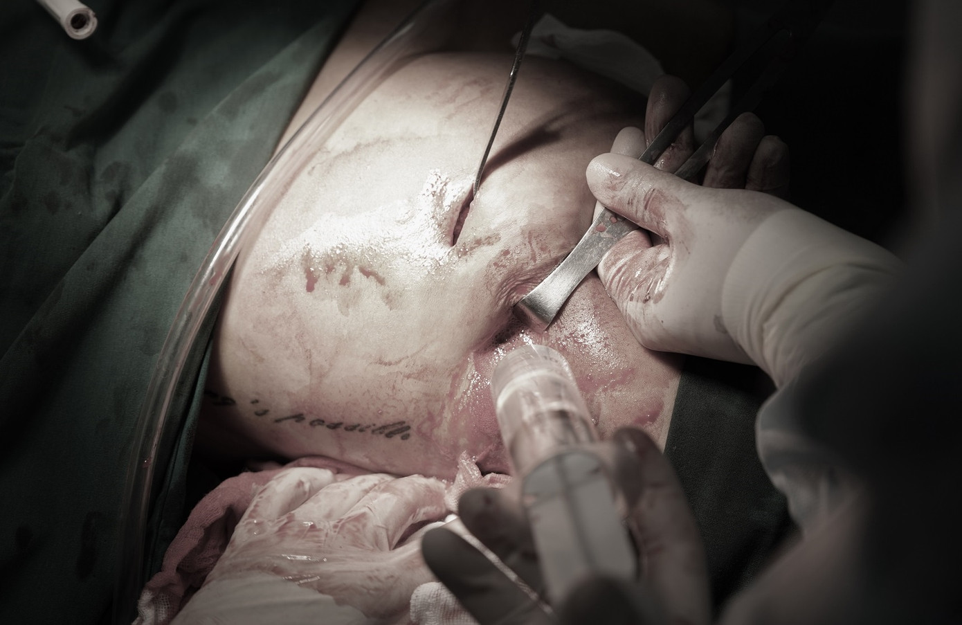 Cả hai bên mông của người bệnh bị hoại tử nặng sau khi tiêm chất làm đầy Cả hai bên mông của người bệnh bị hoại tử nặng sau khi tiêm chất làm đầy