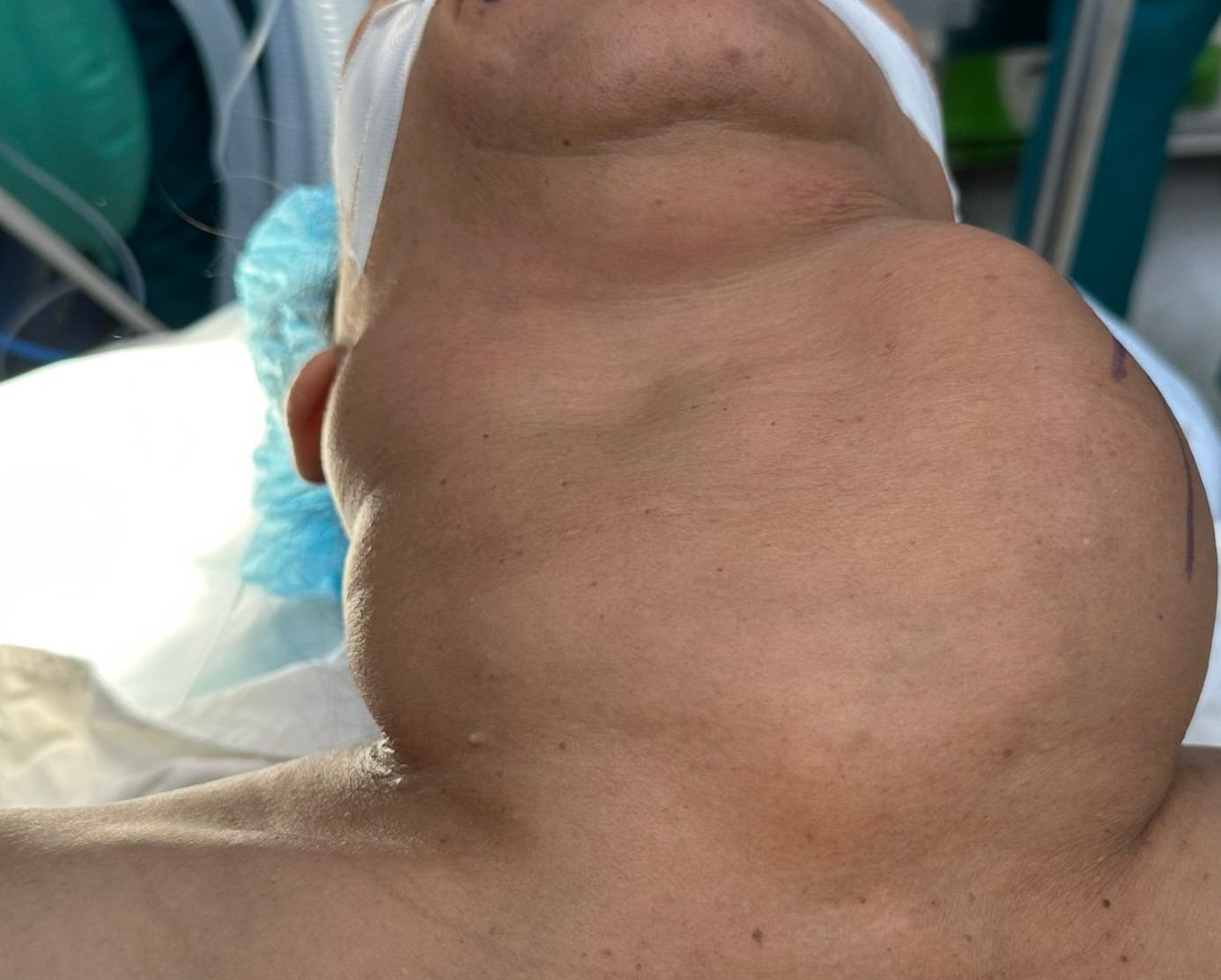 Khối bướu khổng lồ trên cổ bệnh nhân trước khi được bác sĩ thực hiện phẫu thuật Khối bướu khổng lồ trên cổ bệnh nhân trước khi được bác sĩ thực hiện phẫu thuật