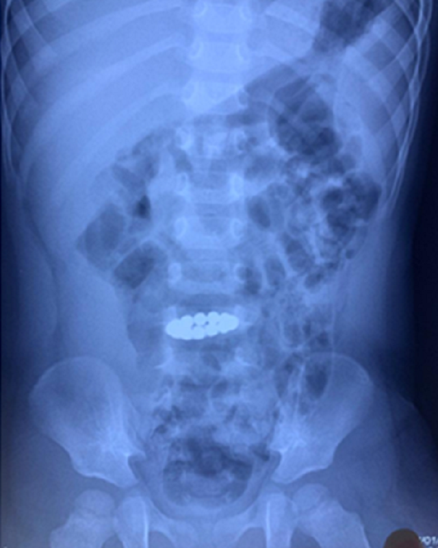Chuỗi nam châm hít vào nhau được phát hiện trên hình ảnh X-quang bụng của bệnh nhi Chuỗi nam châm hít vào nhau được phát hiện trên hình ảnh X-quang bụng của bệnh nhi