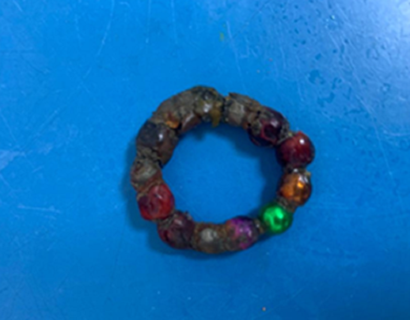 Dị vật được lấy ra từ đường tiêu hóa của bệnh nhi Dị vật được lấy ra từ đường tiêu hóa của bệnh nhi