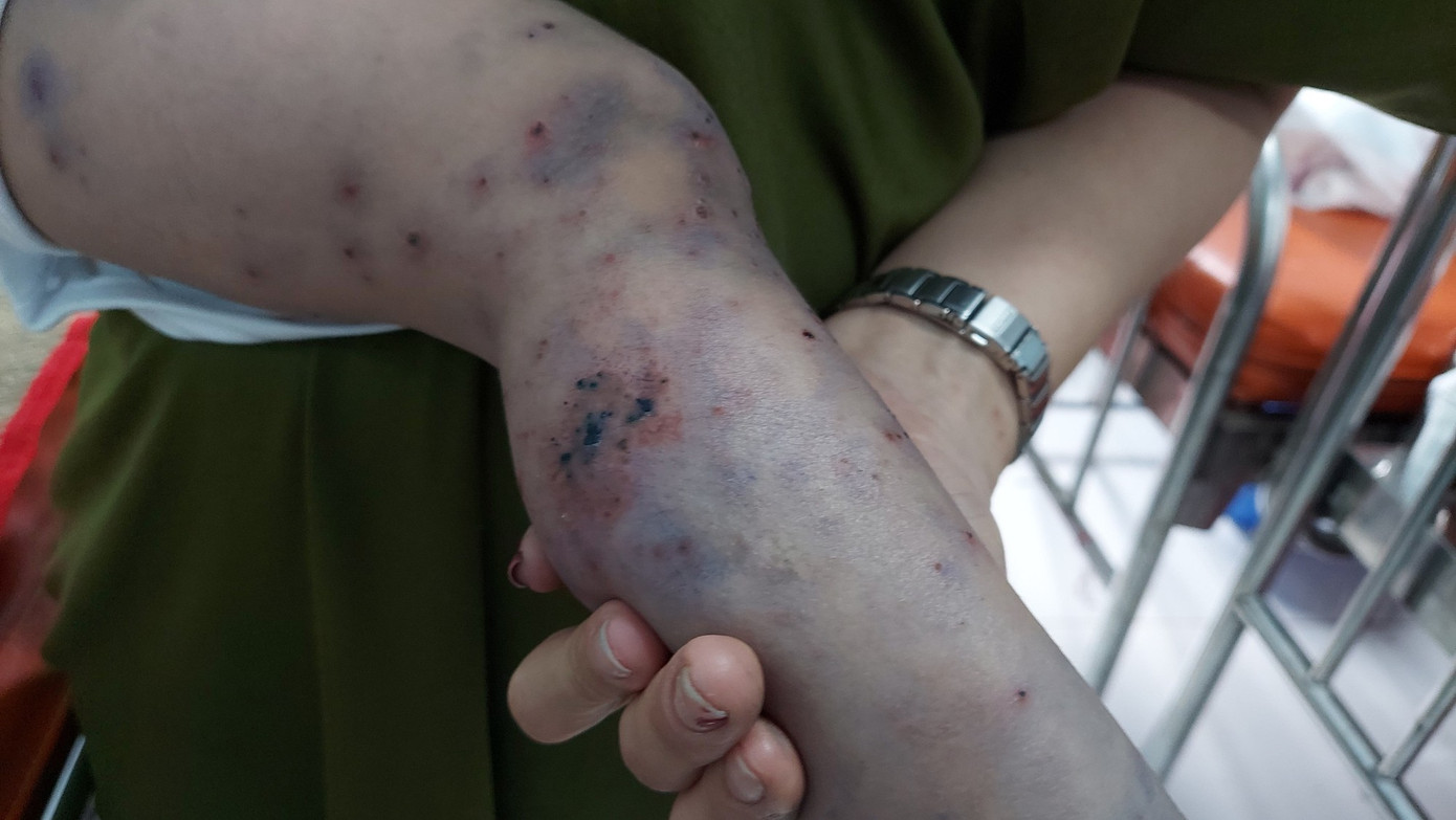 Trẻ mắc bệnh tay chân miệng diễn tiến nặng thường đối mặt với nhiều biến chứng nguy hiểm (Ảnh minh họa)