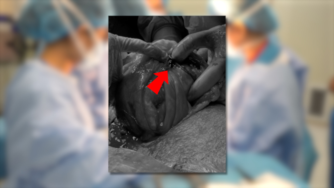 Vị trí tử cung của người bệnh bị vỡ được bác sĩ phát hiện trong quá trình phẫu thuật