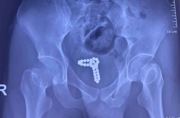 Kết quả kiểm tra hình ảnh cho thấy, chuỗi bi kim loại nằm trong bàng quang của bệnh nhân Kết quả kiểm tra hình ảnh cho thấy, chuỗi bi kim loại nằm trong bàng quang của bệnh nhân