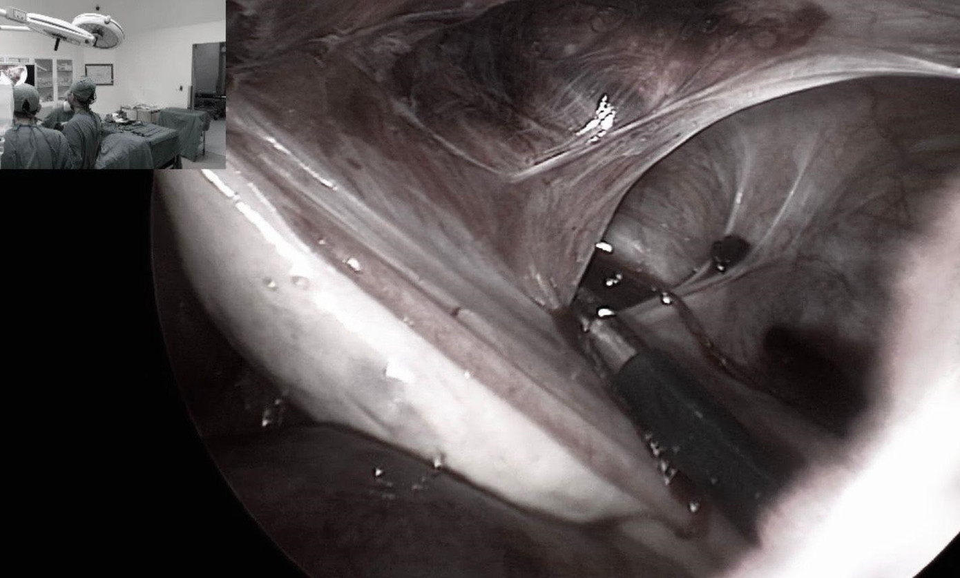 Các bác sĩ thực hiện cuộc nội soi can thiệp tình trạng dính buồng trứng cho bệnh nhân Các bác sĩ thực hiện cuộc nội soi can thiệp tình trạng dính buồng trứng cho bệnh nhân