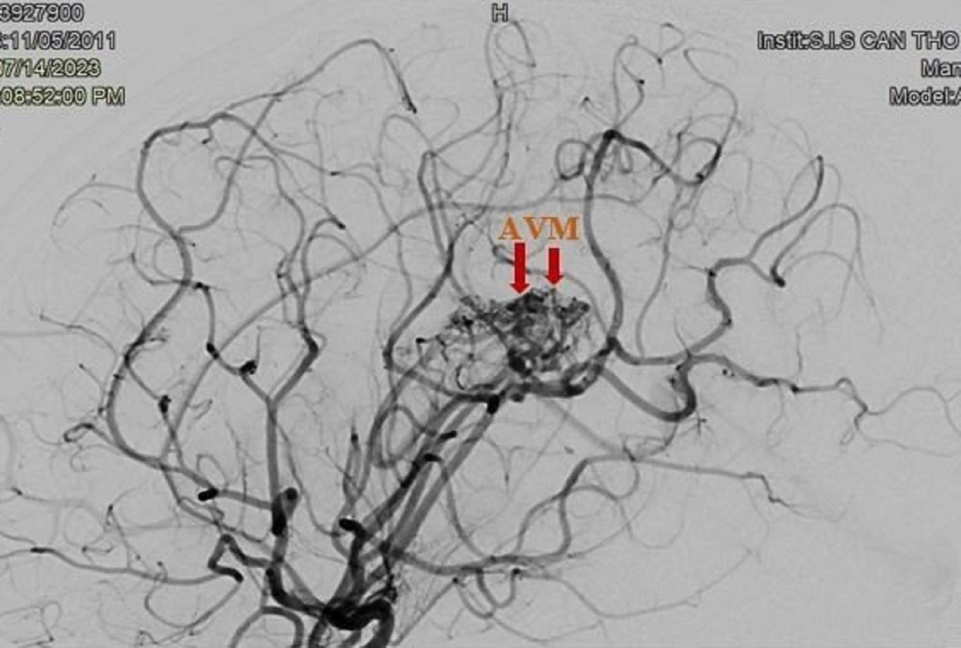 Túi giả phình mạch máu não của bệnh nhân trên hình ảnh kiểm tra Túi giả phình mạch máu não của bệnh nhân trên hình ảnh kiểm tra
