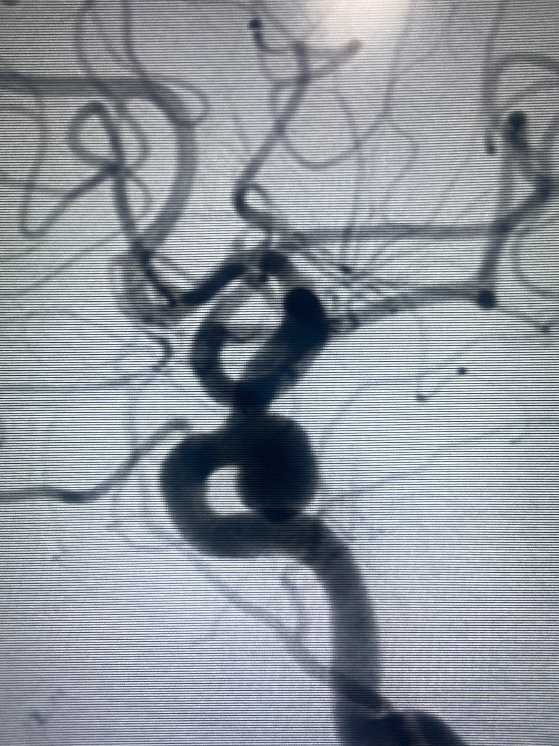 Túi phình mạch máu não ở bệnh nhân qua kết quả chẩn đoán hình ảnh