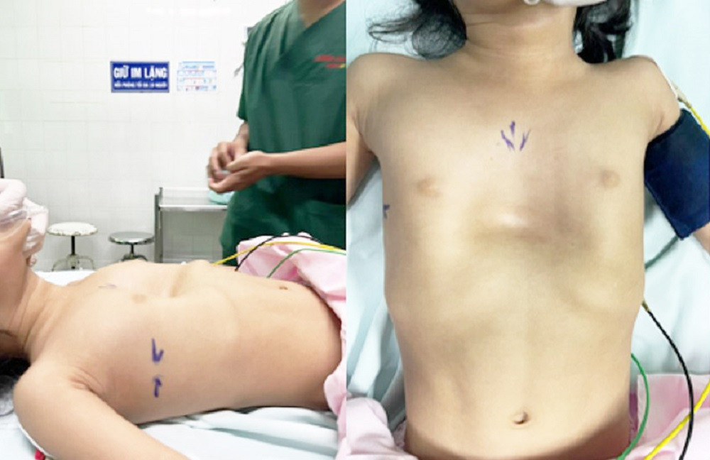 Tình trạng lõm ngực nặng khiến tim phổi của bệnh nhi bị chèn ép đe dọa tính mạng Tình trạng lõm ngực nặng khiến tim phổi của bệnh nhi bị chèn ép đe dọa tính mạng