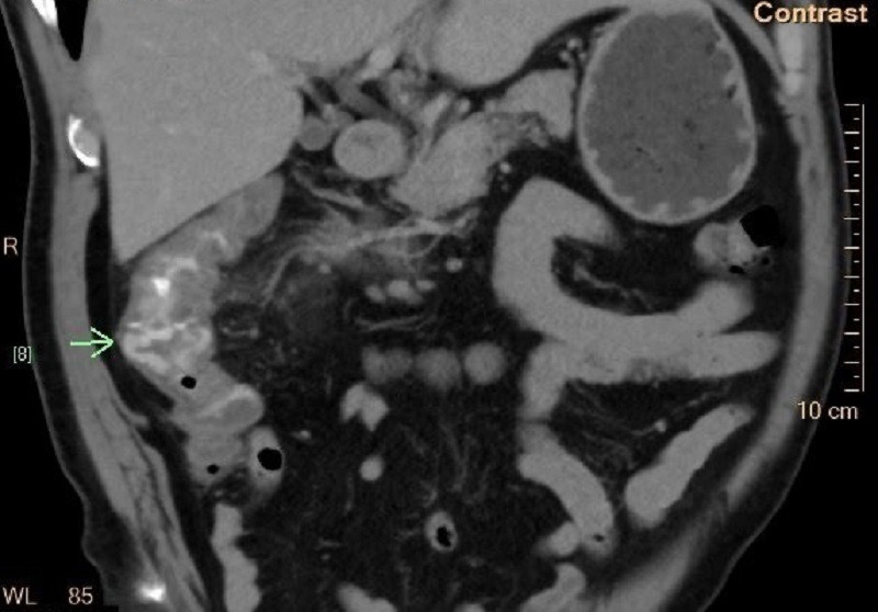 Vị trí túi thừa đại tràng bị viêm gây xuất huyết ồ ạt khiến bệnh nhân mất máu cấp