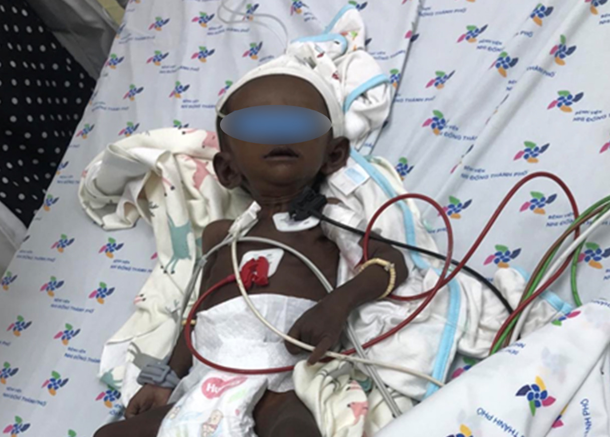 Thiểu sản tuyến thượng thận là nguyên nhân khiến bé gái người Việt có màu da đen