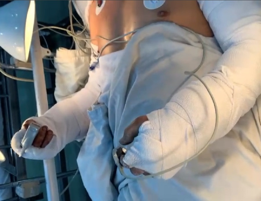 Nam công nhân đã được bác sĩ thực hiện thành công cuộc phẫu thuật nối lại 2 cẳng tay Nam công nhân đã được bác sĩ thực hiện thành công cuộc phẫu thuật nối lại 2 cẳng tay