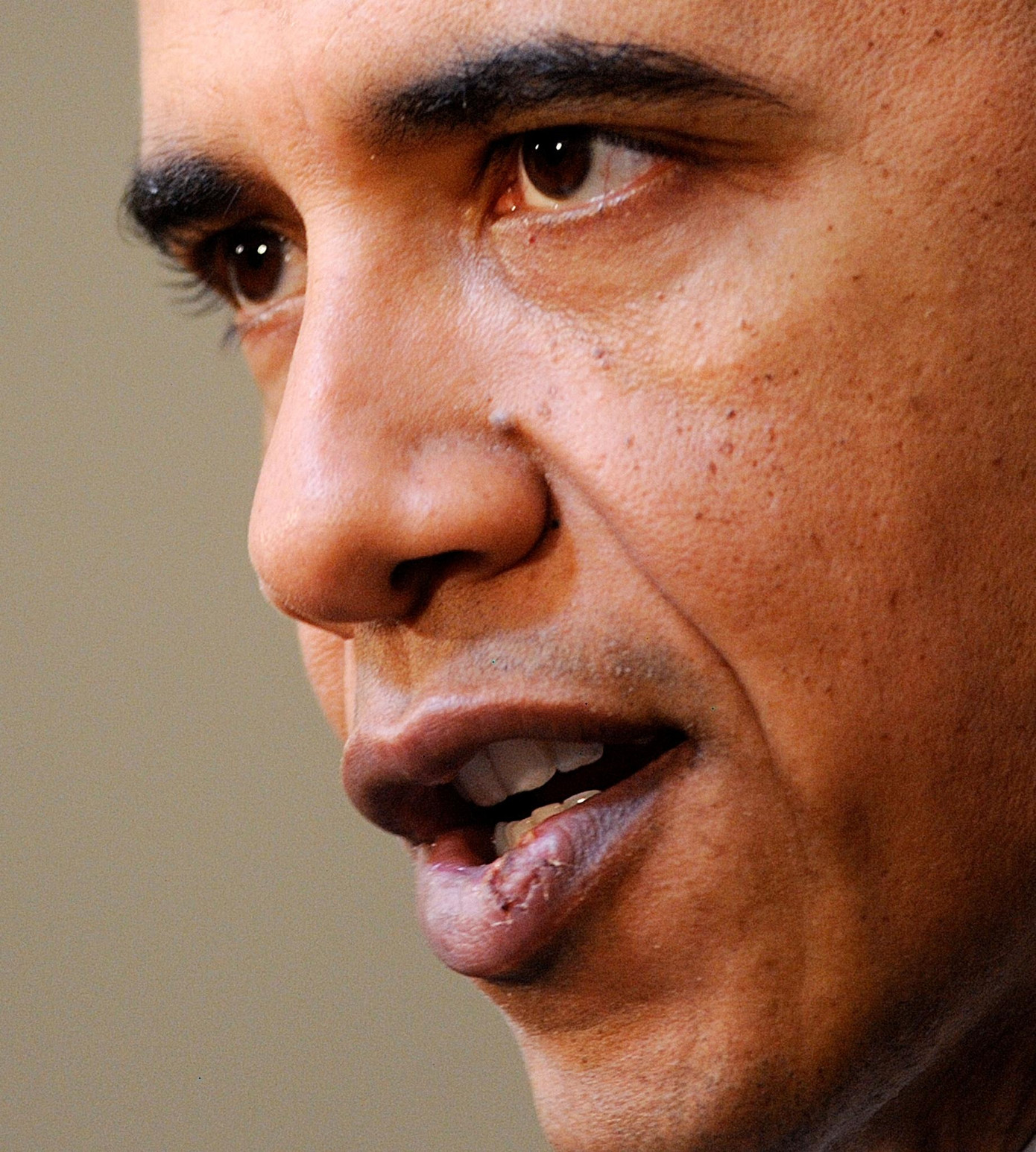 Vết thương ở môi ông Obama từng gây xôn xao dư luận một thời. Ảnh: Getty Images.