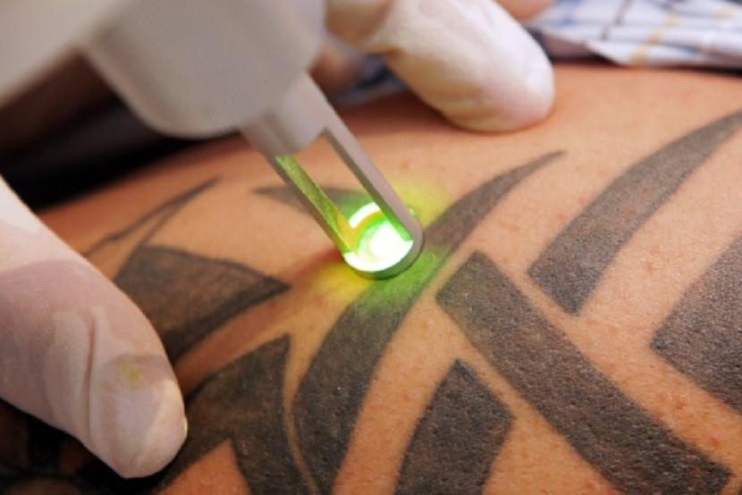 Nam thanh niên đã rơi vào tình trạng sốc phản vệ, nguy kịch khi đi xóa hình xăm (ảnh minh họa)