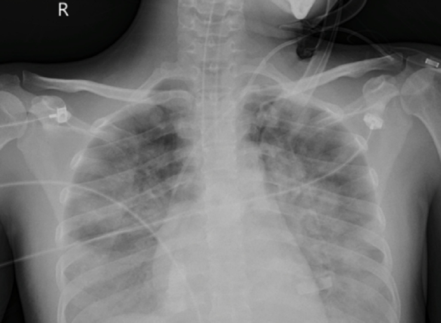 Phổi của nữ bệnh nhân bị tổn thương rất nặng cả hai bên phổi do nhiễm 'vi khuẩn ăn thịt người' Phổi của nữ bệnh nhân bị tổn thương rất nặng cả hai bên phổi do nhiễm 'vi khuẩn ăn thịt người'