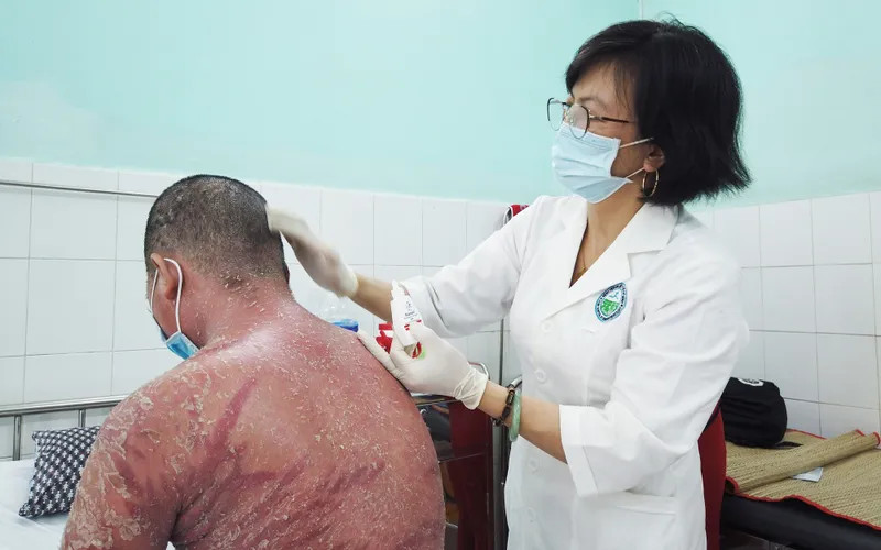 Nam thanh niên đã bị "lột da" toàn thân sau khi sử dụng thuốc trôi nổi trên mạng xã hội để trị bệnh vảy nến Nam thanh niên đã bị "lột da" toàn thân sau khi sử dụng thuốc trôi nổi trên mạng xã hội để trị bệnh vảy nến