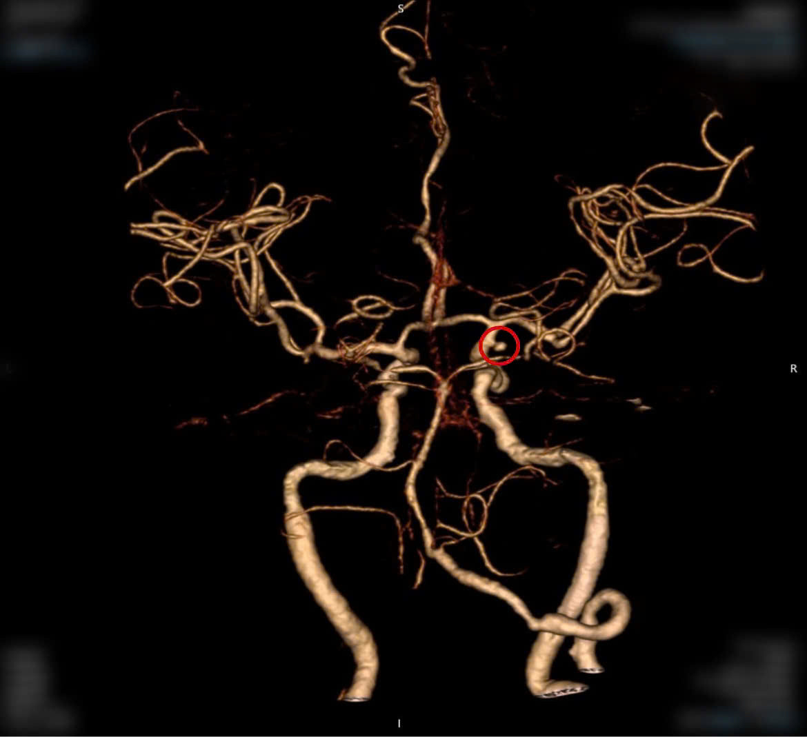 Hình ảnh mạch máu của bệnh nhân trên phim CTA- tình cờ phát hiện 1 túi phình động mạch (vị trí khoanh tròn đỏ)